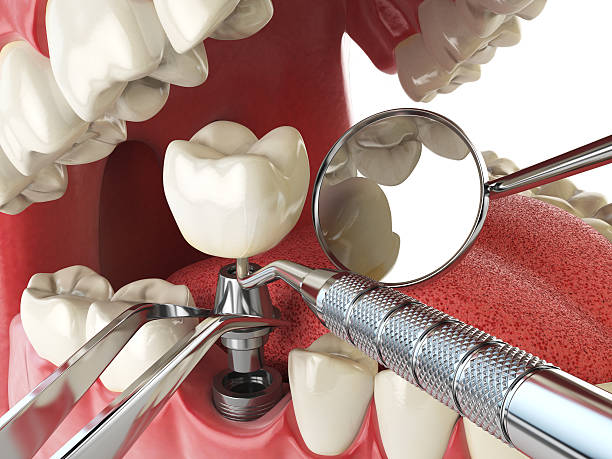 Best Emergency Tooth Extraction in Perry, FL